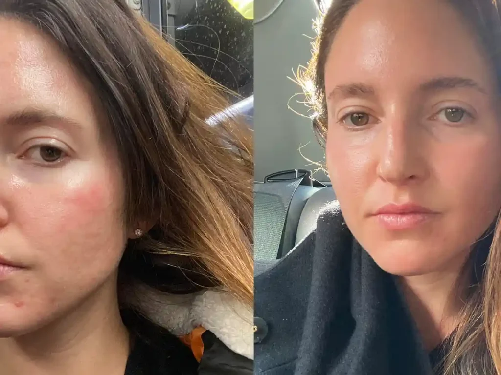 How Often Can You Have Total Skin Tightening Treatment? 1 Explaining Total Skin Tightening Treatment and What to Expect